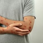 Anonymous person with monkeypox, monkey pox epidemic