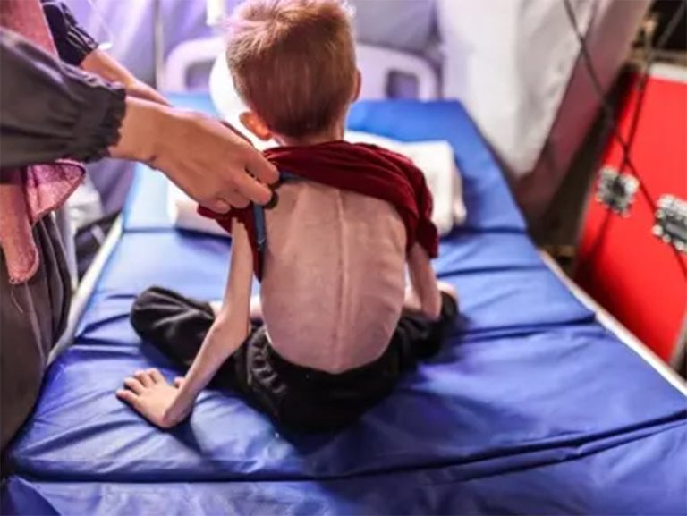 Gaza-Nino-Desnutricion-1