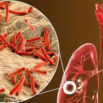 TUBERCULOSIS-1